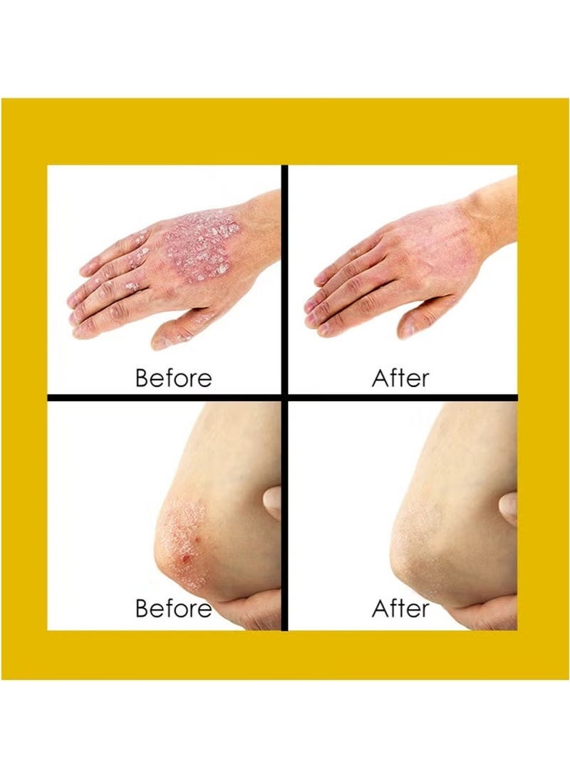 سوميفون كريم الصدفية لمشاكل الجلد المتعددة ، مثل الصدفية والأكزيما والتهاب الجلد والحكة (20g) - Image 3